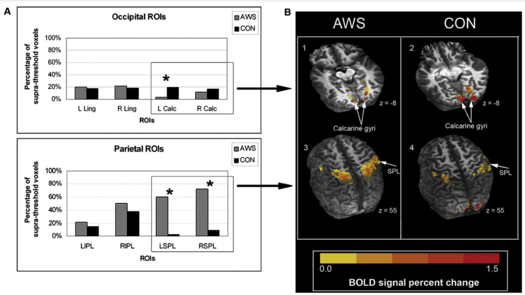 Figure 1 (Brumm et al., 2010)
(A) Mean percentage of BOLD signal change for each region of interest (ROI) for child with AIWS (AWS) and control participant (CON). (B) fMRI images showing activation patterns (1, 2: occipital lobe, 3, 4: parietal lobe)
